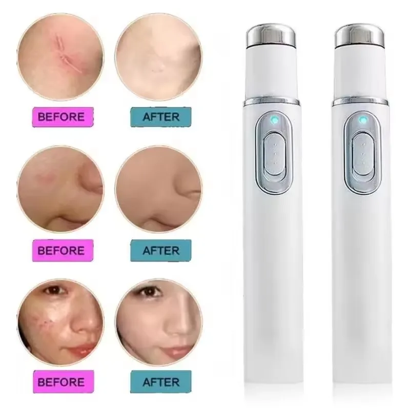 Stylo de thérapie à la lumière - Acne Light Therapy Pen avis et prix